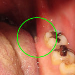 歯茎から飛び出た歯槽骨
