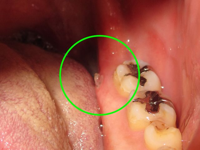 歯茎から飛び出た歯槽骨