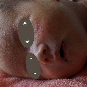 顔に出来た乳幼児湿疹