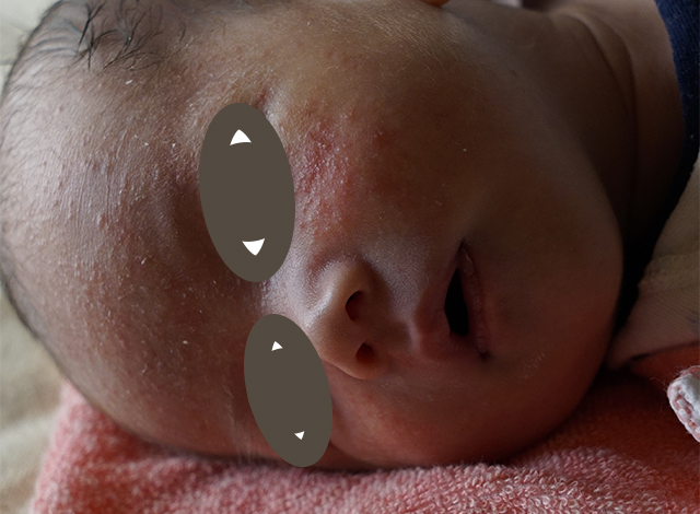 顔に出来た乳幼児湿疹